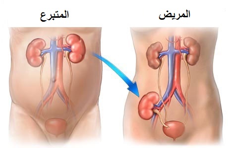 Kidney Transplant